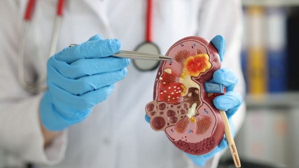 A healthcare professional in blue gloves holds a detailed model of a kidney, pointing to a representation of a tumor with tweezers. This educational image could be used to discuss direct and indirect expenses involved in renal cancer treatment. The background is softly focused, featuring medical equipment, suggesting a clinical setting.